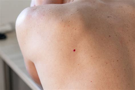 What Causes Red Moles On Skin And How To Get Rid Of Them Health Care