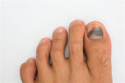 Bruise Underneath The Toenail Subungual Hematoma Oc Foot And Ankle