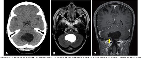 Pdf Fourth Ventricle Neurenteric Cyst Mimicking Hemangioblastoma