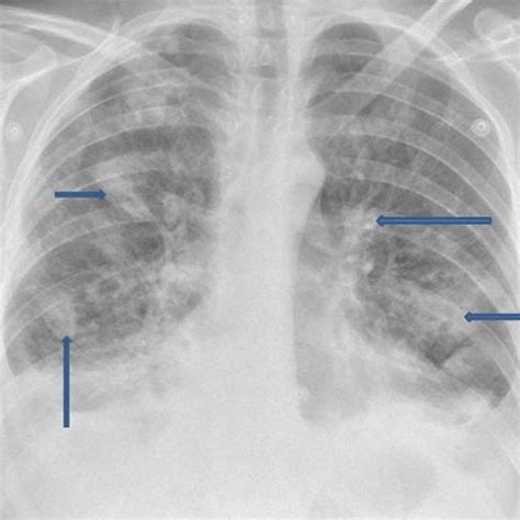 Plain Chest Radiograph Showing Multiple Irregularly Defined Patches Of
