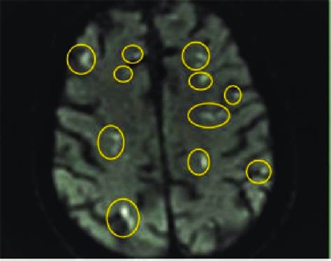 Mri Brain Showing Multiple Bilateral Embolic Infarcts Download