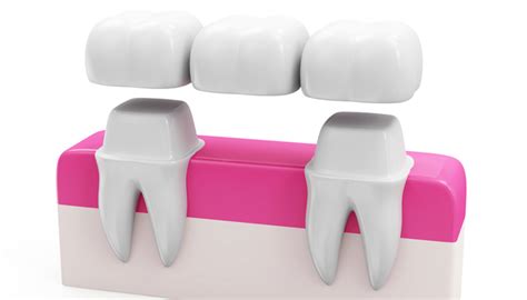 Dental Bridges Replace Missing Teeth Nhs Dental Bridge Chelmsford