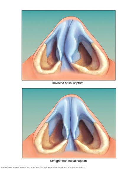 13 Best Nose Types And Rhinoplasty Diagrams Images On Pinterest