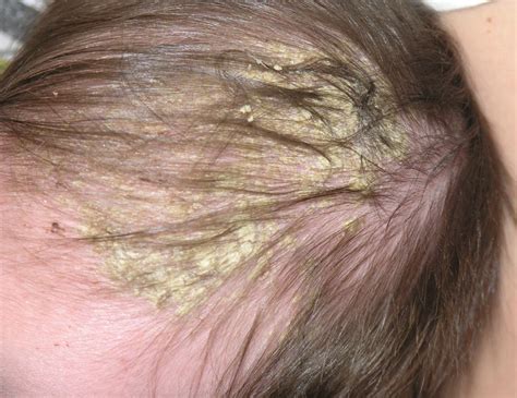 Cradle Cap On Babies Scalp Program Scalp And Hair Loss Therapy