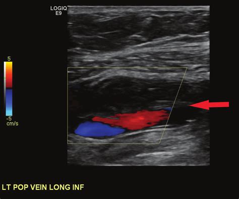 Lower Extremity Venous Duplex Scan
