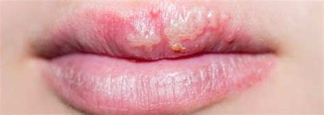 Common Oral Lesions Canker Sores Herpes And Thrush Sanident