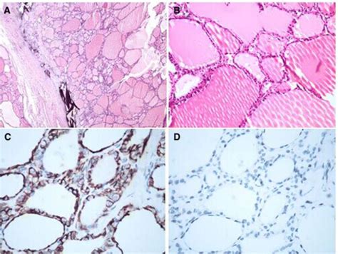 The Thyroid Multinodular Goiter Contains Normal Thyroid Follicles With