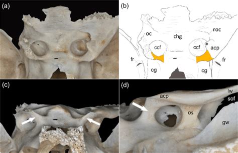 Bilateral Complete Caroticoclinoid Foramen Present On An Isolated