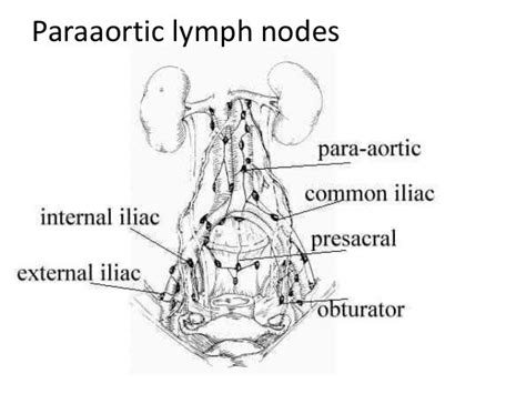 Internal Iliac Lymph Nodes