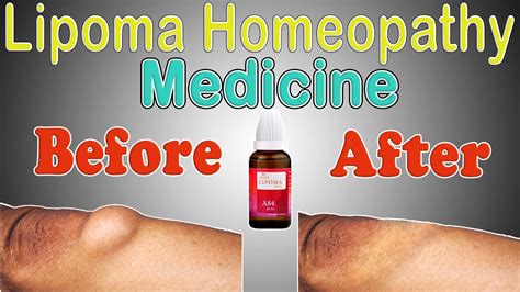 Lipoma Treatment In Homeopathy Captions Energy