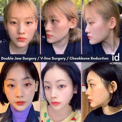 Our Patient Had The Id Plastic Surgery Hospital Korea