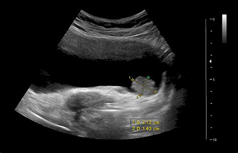 Detecting Bladder Cancer With A Ct Scan Ultrasound Or Mri Cxbladder