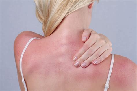 Remedies To Ease Sunburns Skinsmart Dermatology