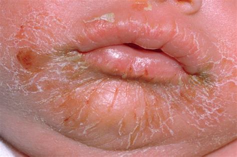 Skin Rashes In Babies Nhsuk