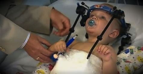 Toddler Has Head Reattached In Miracle Surgery