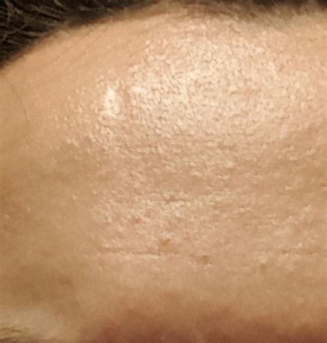 Skin Concerns How Do I Fix This On My Forehead I Am A Male Teen With