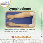 What Is Lymphedema And Why Should You Care