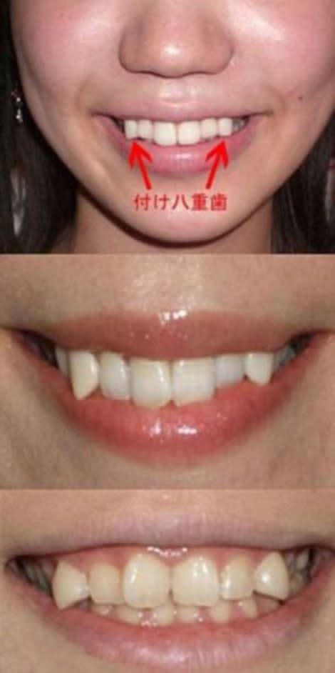 Japanese Snaggletooth Craze Spawns Dental Procedures Girl Group