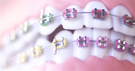 Braces How Are They Made Belmar Orthodontics