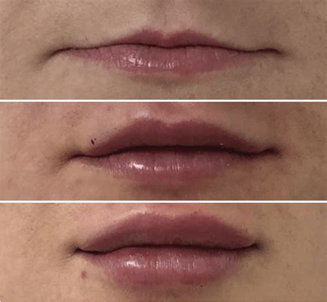 Técnica propuesta para mejorar el aspecto de un labio fino y o