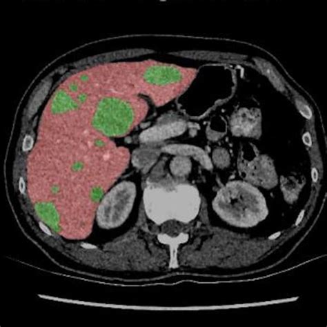 Liver Tumor Segmentation In Tfrecords Part 3 Kaggle