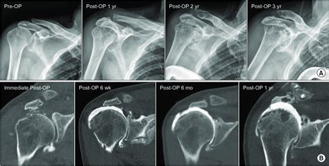A Anteroposterior Radiograph Of Right Shoulder Before And After