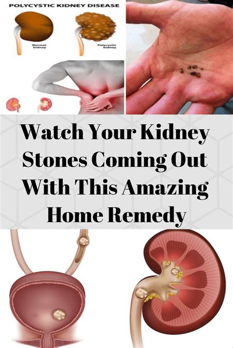 Watch Your Kidney Stones Coming Out With This Amazing Home Remedy