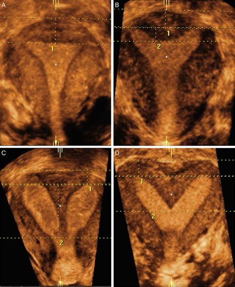 Partial Septate Uterus Ultrasound