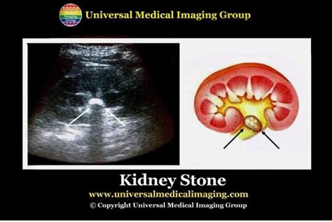 What Causes Kidney Stones And How To Remove Them Naturally