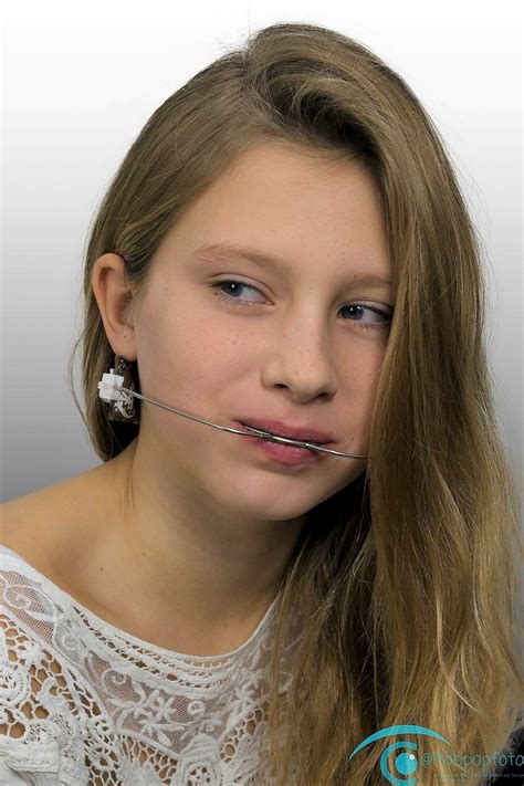 Pin By John Beeson On Girls In Headgear In 2021 Teeth Braces Braces Girls Orthodontic Appliances