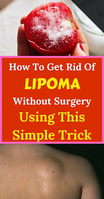 How To Get Rid Of Lipoma Without Surgery Using This Simple Trick