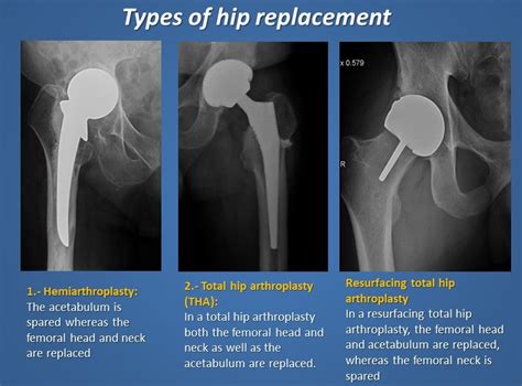 Review Of Imaging Modalities Of Hip Arthroplasty All In One Photos