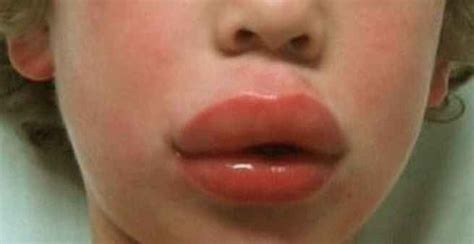 Upper Lip Swollen Causes