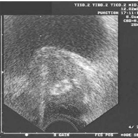 Transrectal Ultrasound Prostate Biopsy On The Right Side The Trace Of