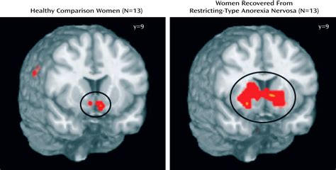 Altered Reward Processing In Women Recovered From Anorexia Nervosa