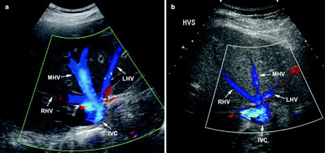Portal Vein Anatomy Ultrasound