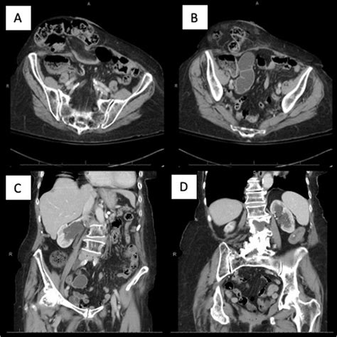 A Axial Image Of Parastomal Hernia With Bowel Contents B Axial Image