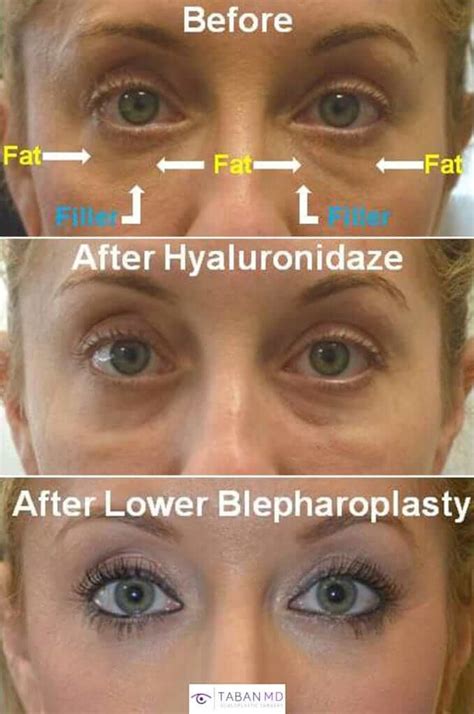 Lower Blepharoplasty Before And After Gallery Taban Md Under Eye