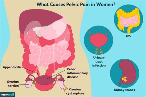 What Pelvic Pain Is Health Nigeria