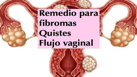 Remedio Fibromas Miomas Quistes De Ovario Y Flujo Vaginal Ecodaisy Youtube