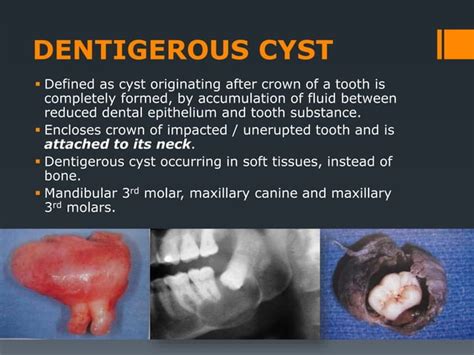 Cysts Of Oral Regions Ppt