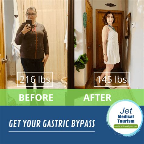 Gastric Bypass Weight Loss Chart Timeline 2022 Jet Medical Tourism®