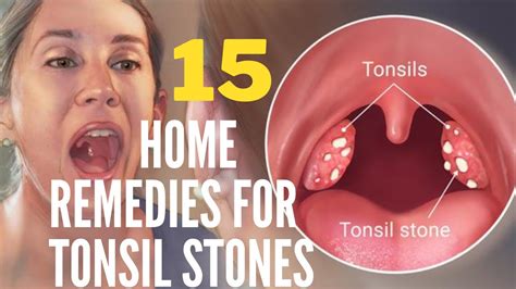 15 Home Remedies For Tonsil Stones That Work Fast Youtube