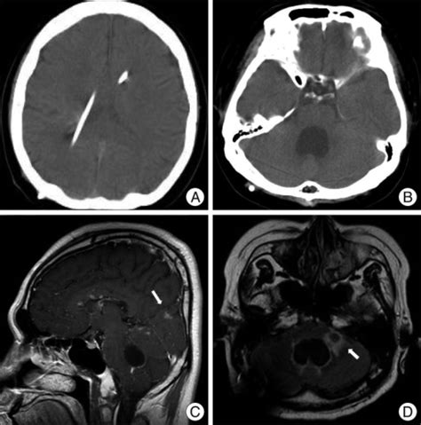 Figure 3treatment Of Hydrocephalus Associated With Neurosarcoidosis By
