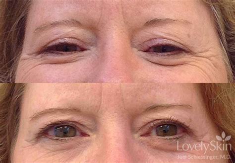 Omaha Cosmetic Dermatology Latisse Skin Specialists Pc Lovelyskin™