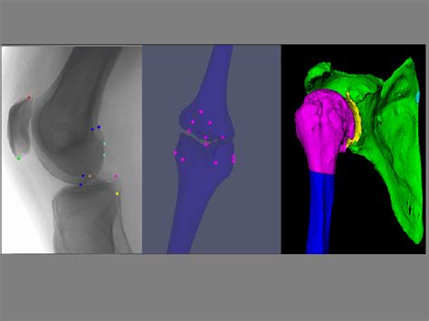 Custom Ai Software And Modules For Orthopedics By Rsip Vision