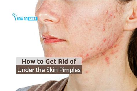 How To Get Rid Of Under The Skin Pimples Pimples Skin Discoloration