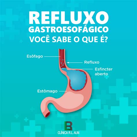 refluxo gastroesofágico sintomas causas e tratamento euroclinix sexiz pix