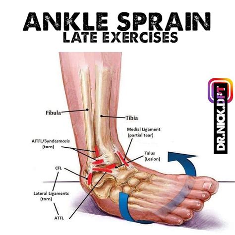 An Ankle Sprain Is Shown With Labels On It