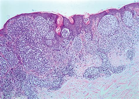 Histopathology Of Malignant Melanoma Proliferation Of Atypical